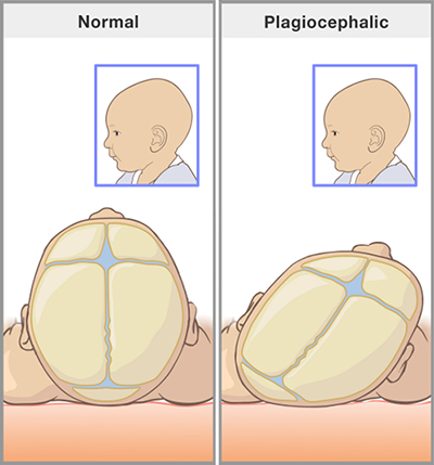 Normal Plagiocephalic
